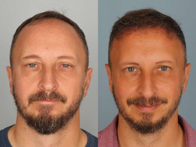 NeoGraft Before & After Gallery - Patient 355532 - Image 1