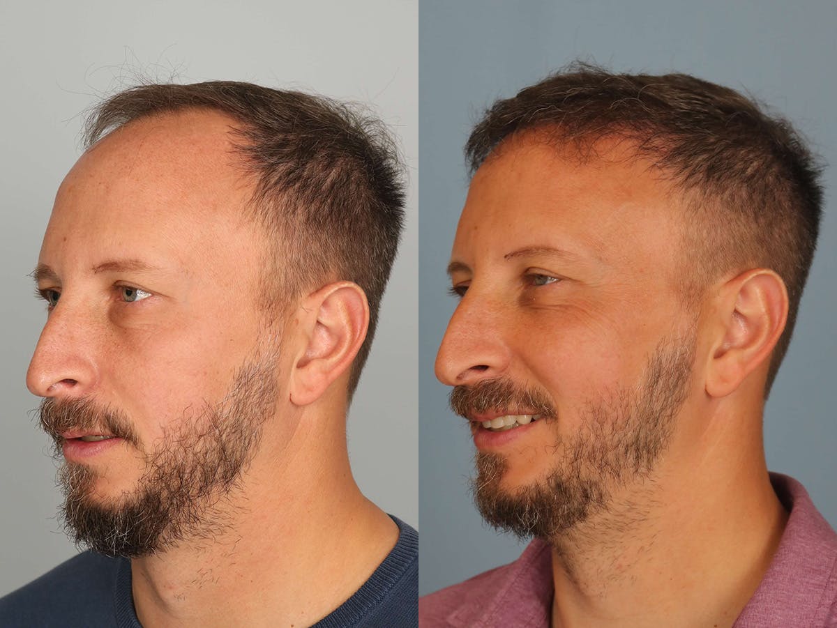 NeoGraft Before & After Gallery - Patient 355532 - Image 2