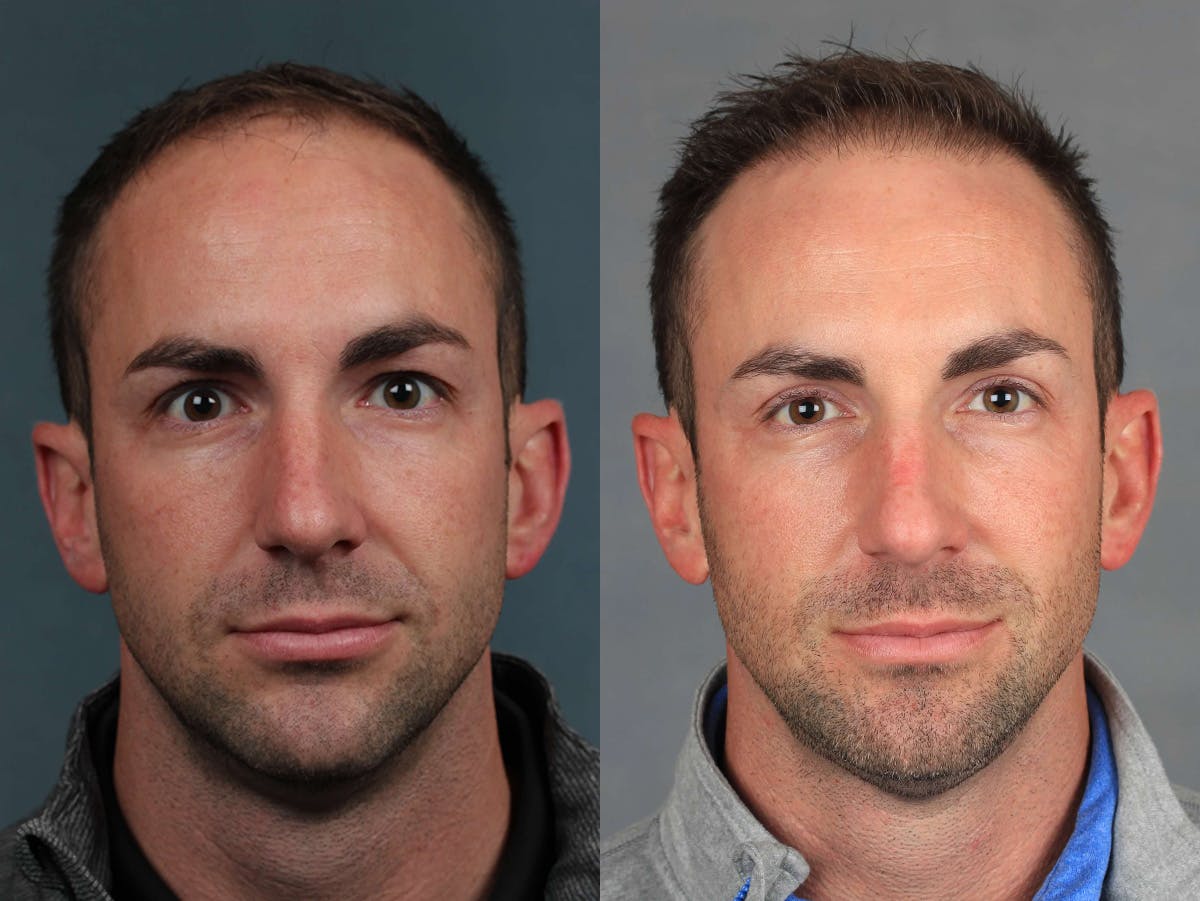 NeoGraft Before & After Gallery - Patient 143789 - Image 1