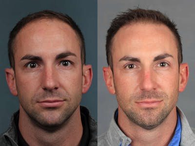 NeoGraft Before & After Gallery - Patient 143789 - Image 1