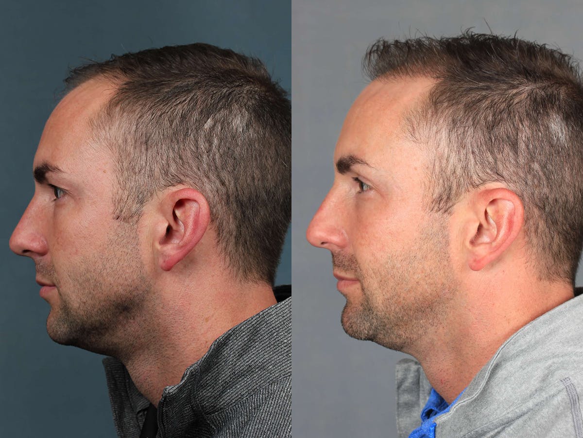 NeoGraft Before & After Gallery - Patient 143789 - Image 3