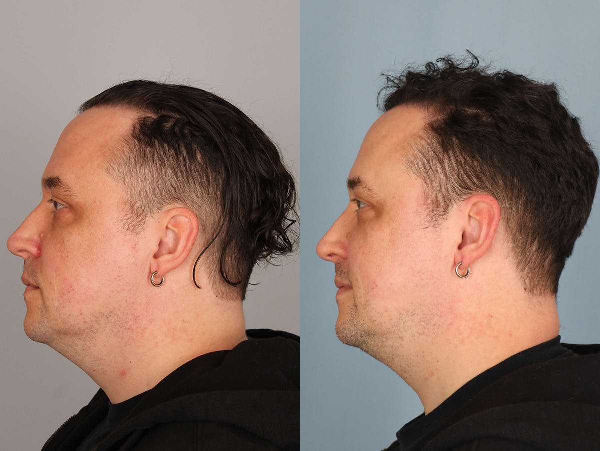 NeoGraft Before & After Gallery - Patient 417137 - Image 3