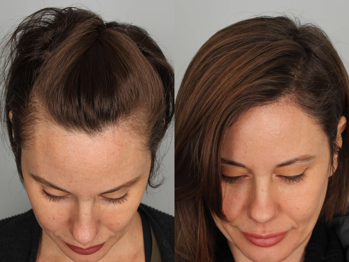 Patient 315926 | NeoGraft Before & After Photos | CaloAesthetics