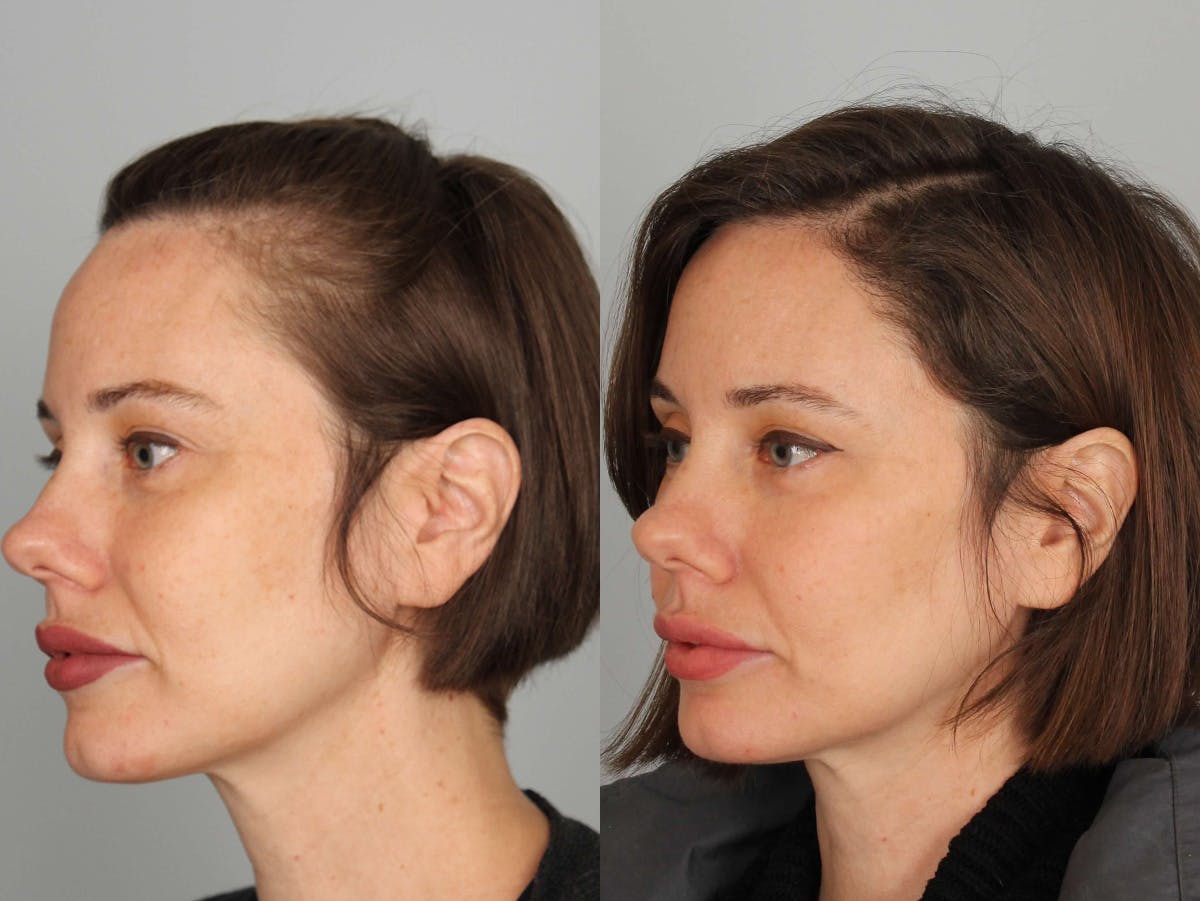 NeoGraft Before & After Gallery - Patient 315926 - Image 2