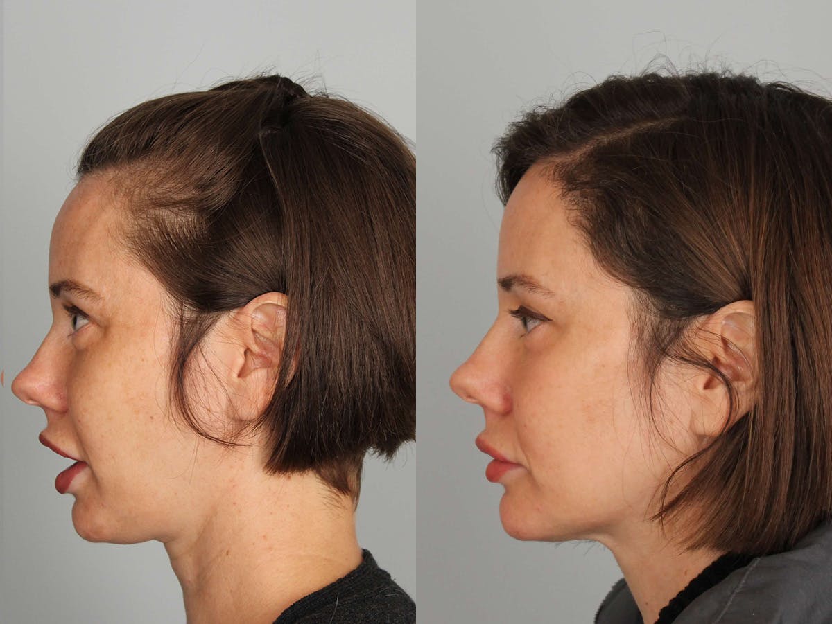 NeoGraft Before & After Gallery - Patient 315926 - Image 3