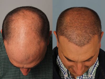 NeoGraft Before & After Gallery - Patient 309701 - Image 1