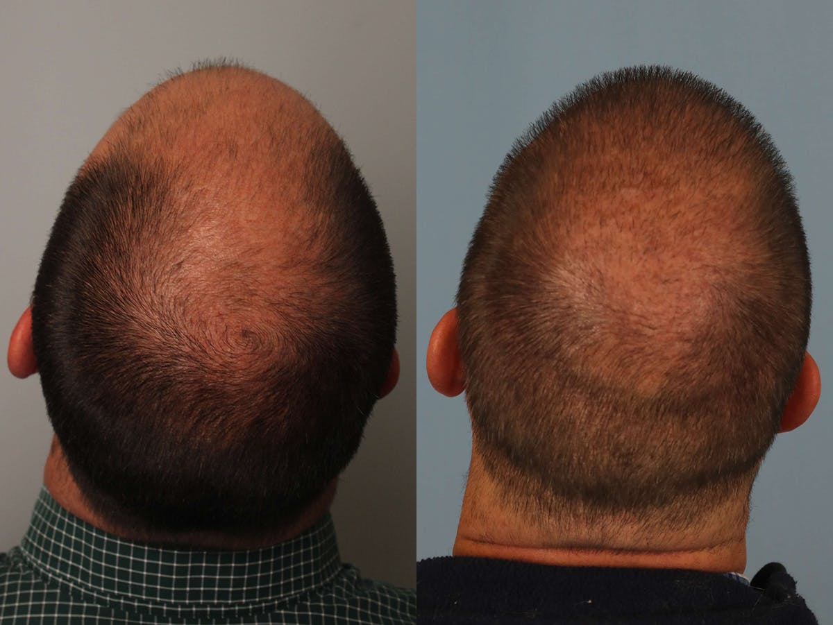 NeoGraft Before & After Gallery - Patient 309701 - Image 2