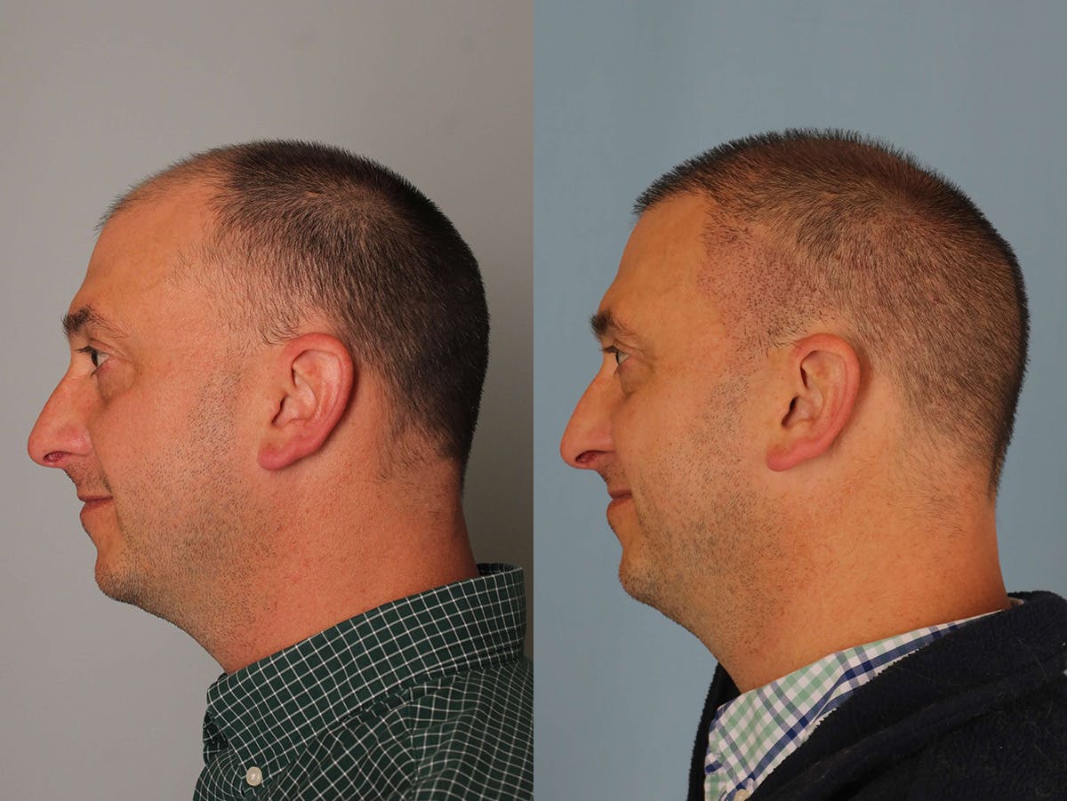 NeoGraft Before & After Gallery - Patient 309701 - Image 3
