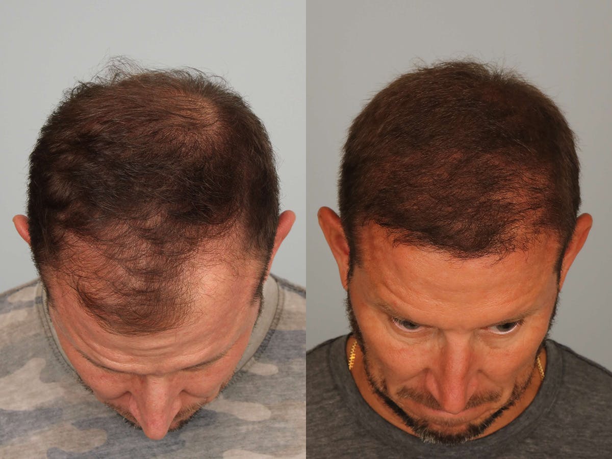 NeoGraft Before & After Gallery - Patient 876741 - Image 1