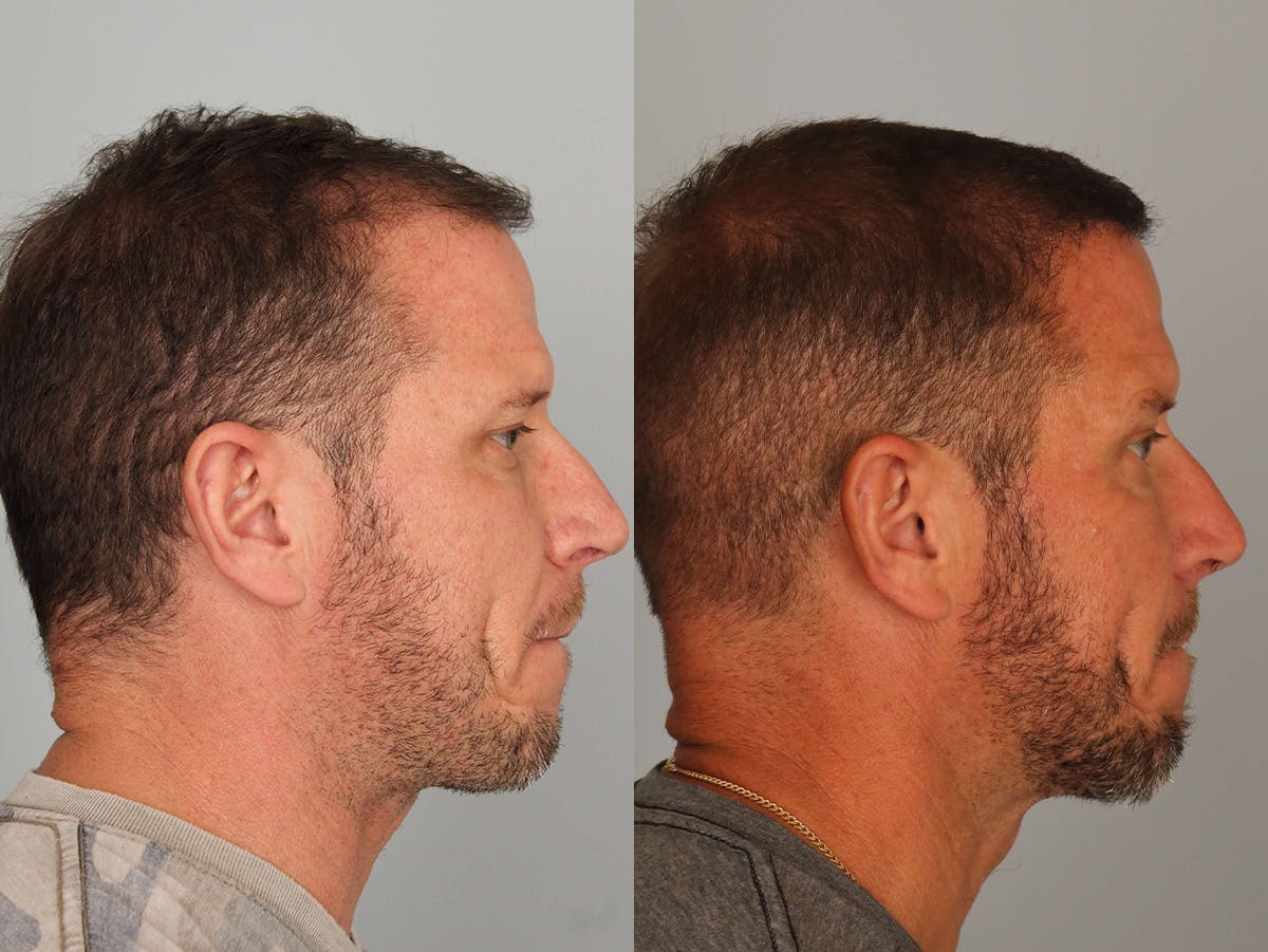 NeoGraft Before & After Gallery - Patient 876741 - Image 2