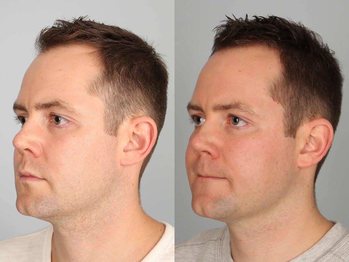 NeoGraft Before & After Gallery - Patient 540339 - Image 3