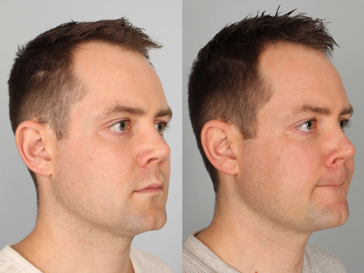 NeoGraft Before & After Gallery - Patient 540339 - Image 2