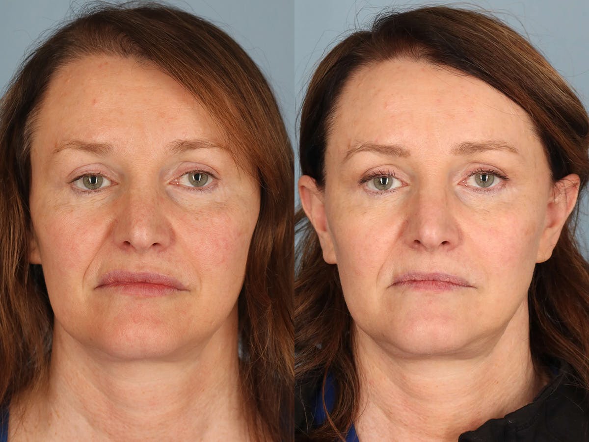 NeoGraft Before & After Gallery - Patient 170595 - Image 1