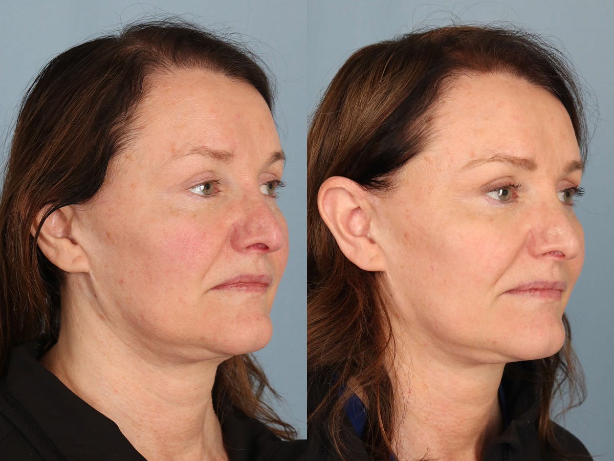 NeoGraft Before & After Gallery - Patient 170595 - Image 2