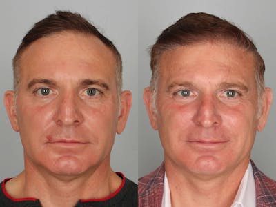 NeoGraft Before & After Gallery - Patient 374038 - Image 1