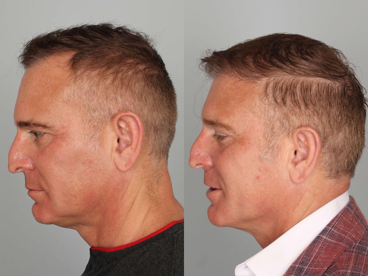 NeoGraft Before & After Gallery - Patient 374038 - Image 3