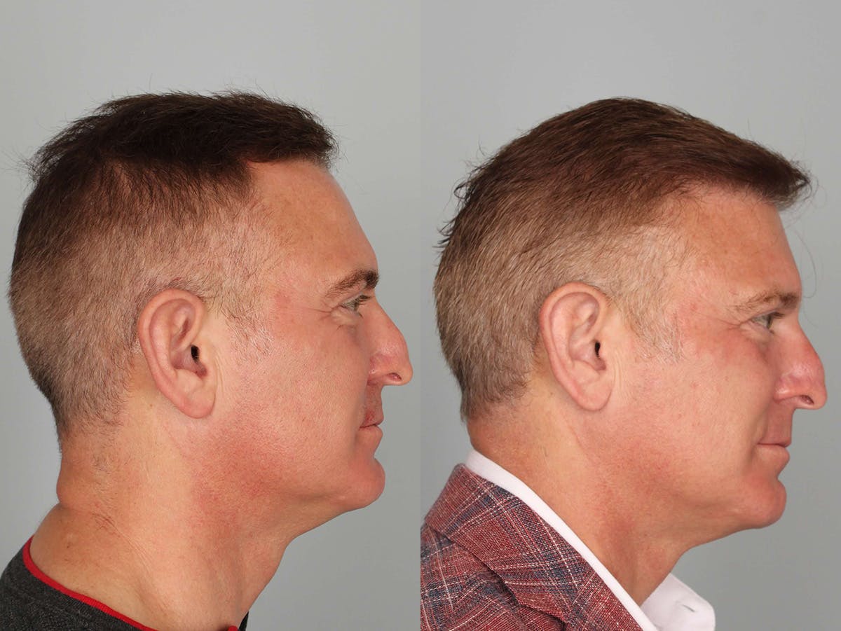 NeoGraft Before & After Gallery - Patient 374038 - Image 2
