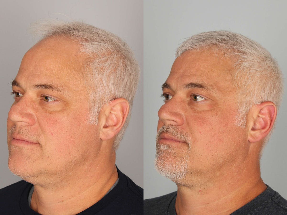 NeoGraft Before & After Gallery - Patient 497154 - Image 2