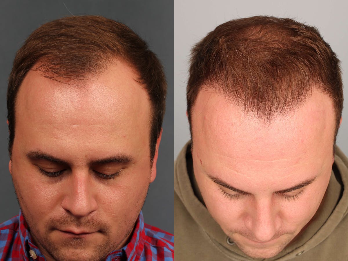 NeoGraft Before & After Gallery - Patient 329041 - Image 1