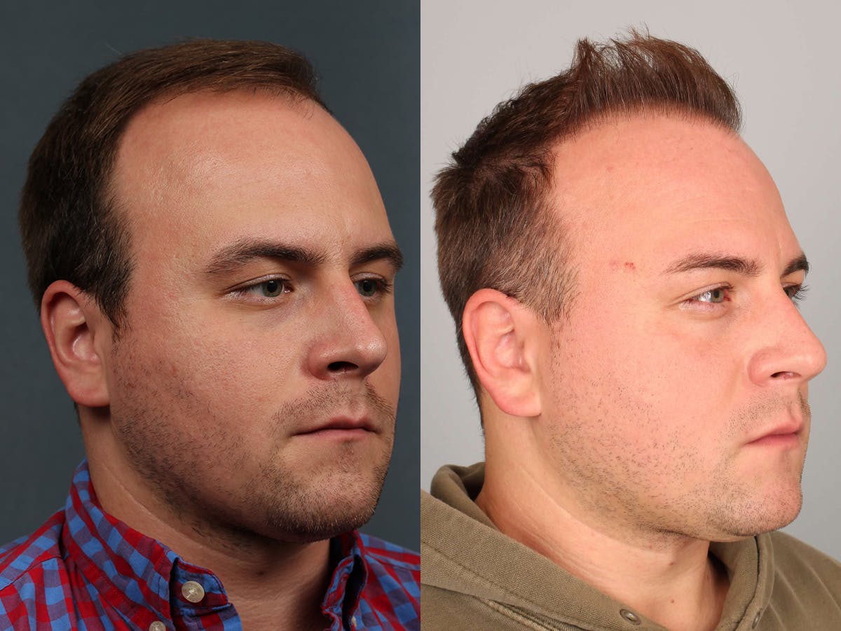 NeoGraft Before & After Gallery - Patient 329041 - Image 2