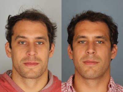 NeoGraft Before & After Gallery - Patient 769408 - Image 1