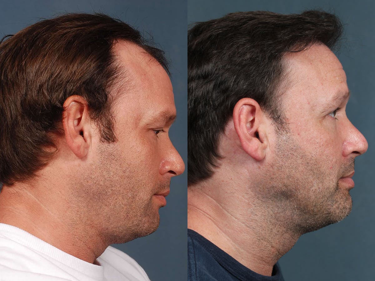 NeoGraft Before & After Gallery - Patient 402956 - Image 2