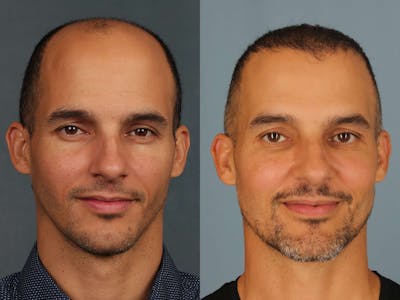 NeoGraft Before & After Gallery - Patient 649919 - Image 1