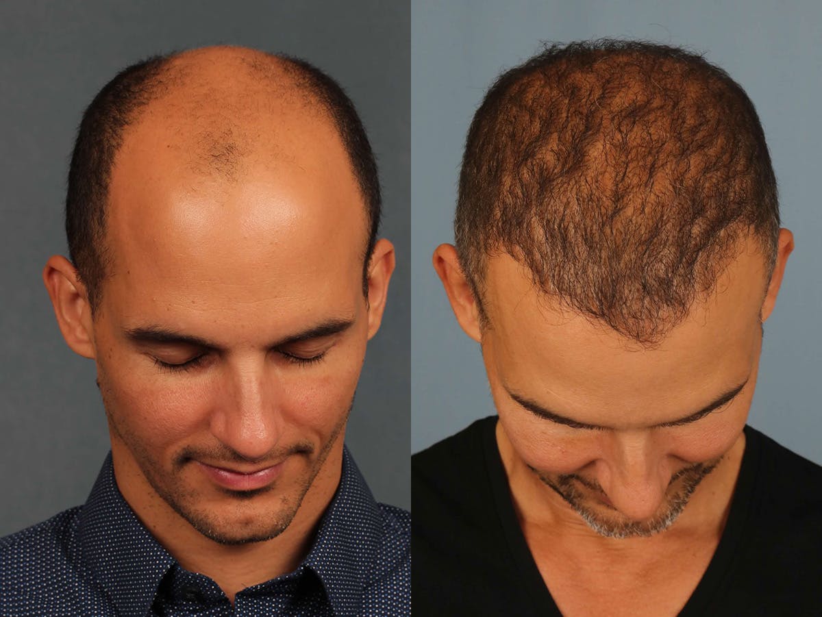 NeoGraft Before & After Gallery - Patient 649919 - Image 3