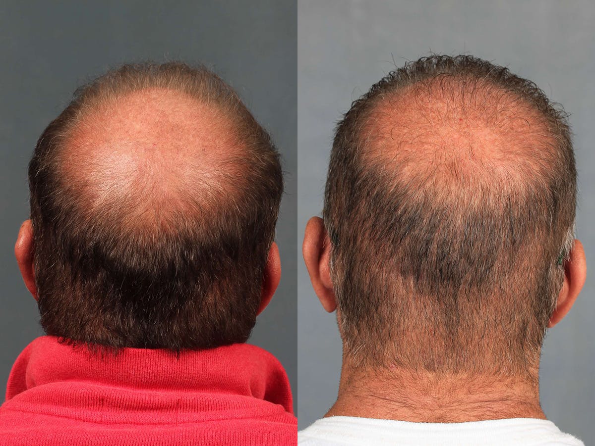 NeoGraft Before & After Gallery - Patient 303898 - Image 2