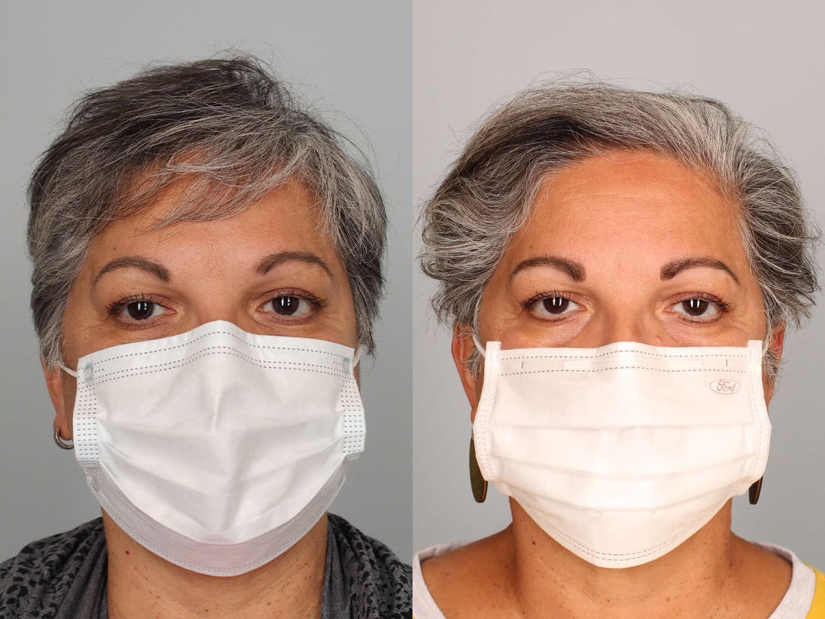 NeoGraft Before & After Gallery - Patient 100939 - Image 1
