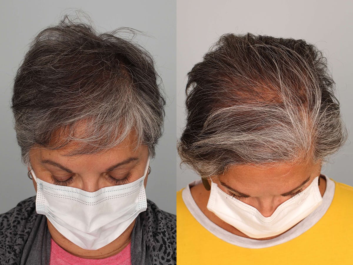 NeoGraft Before & After Gallery - Patient 100939 - Image 2