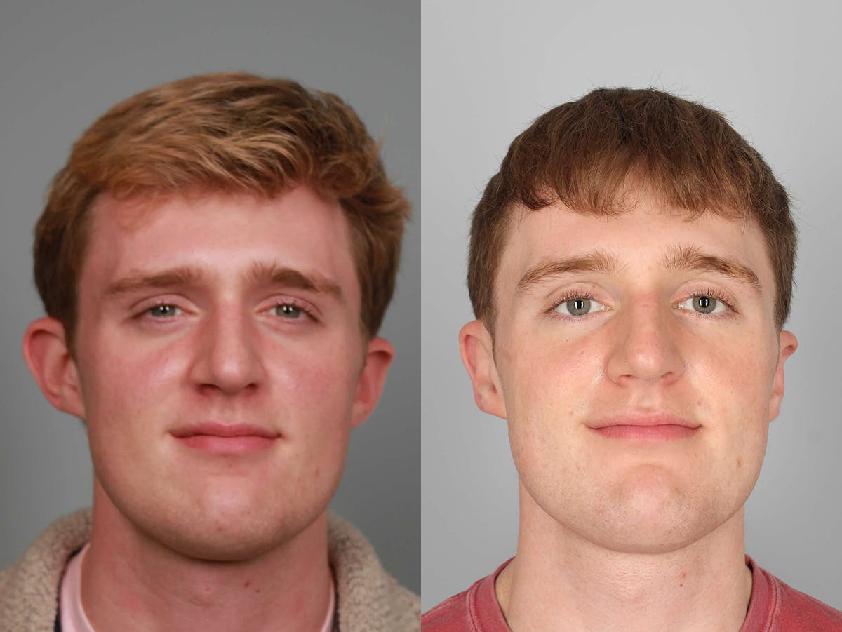 NeoGraft Before & After Gallery - Patient 166060 - Image 1