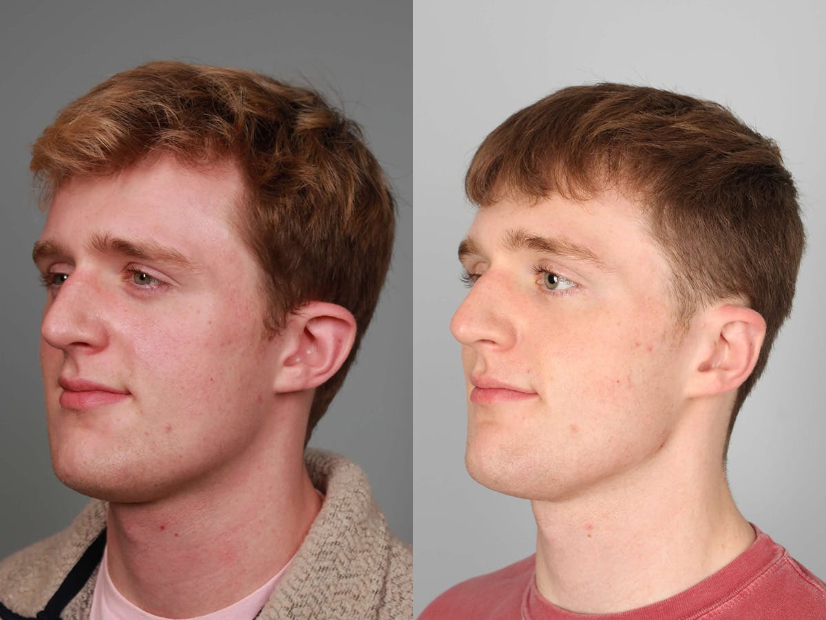 NeoGraft Before & After Gallery - Patient 166060 - Image 3