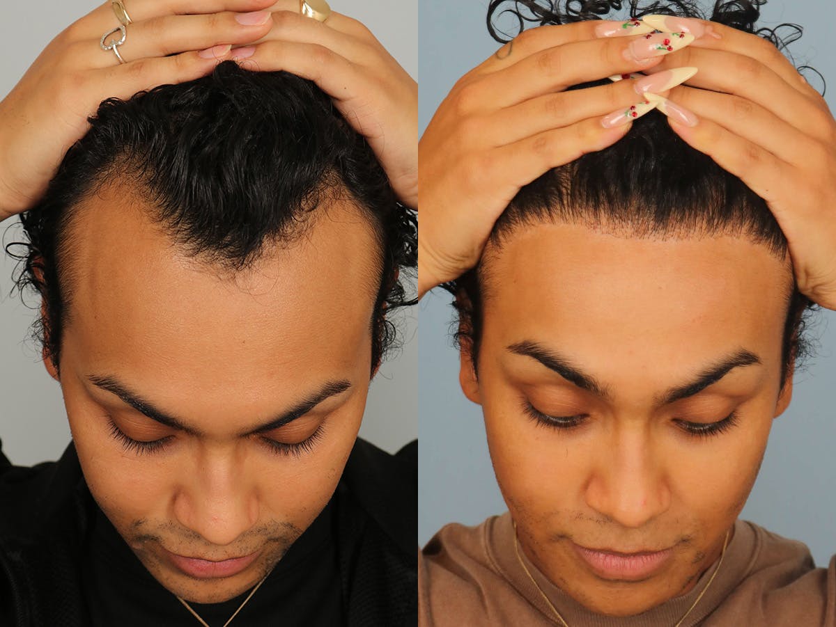 NeoGraft Before & After Gallery - Patient 176094 - Image 2