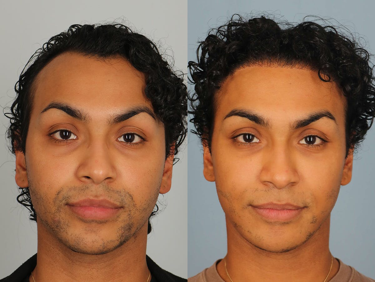 NeoGraft Before & After Gallery - Patient 176094 - Image 1