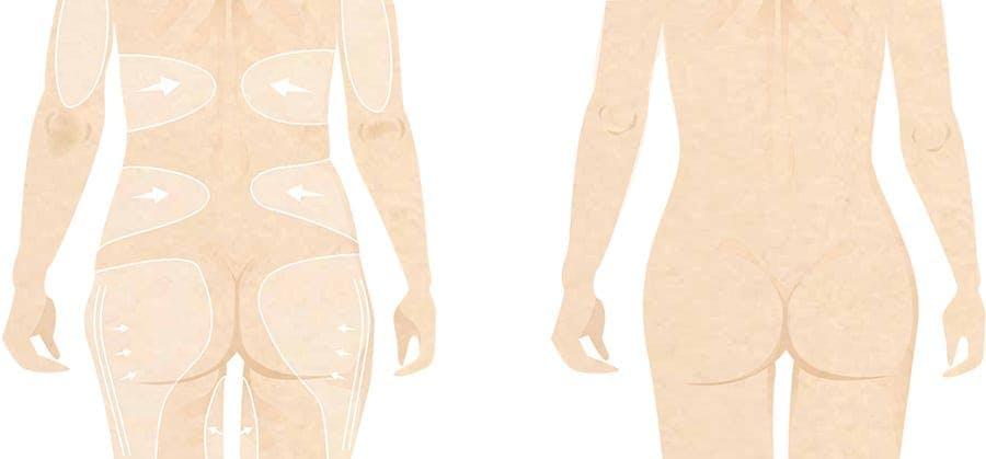 liposuction infograph