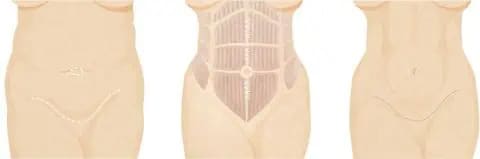 tummy tuck infographic