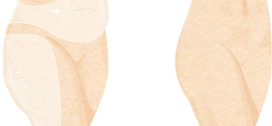 thigh liposuction infographic
