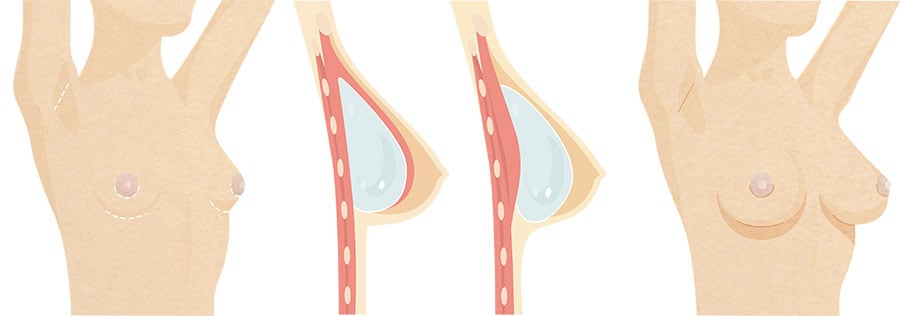 breast augmentation infographic