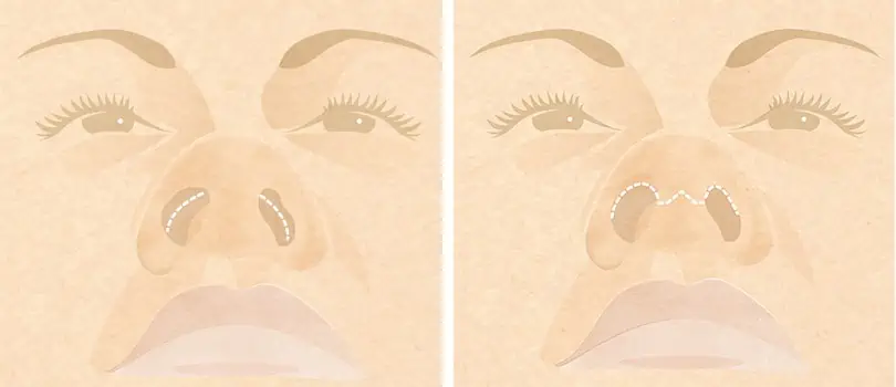 rhinoplasty infographic rhinoplasty infographic