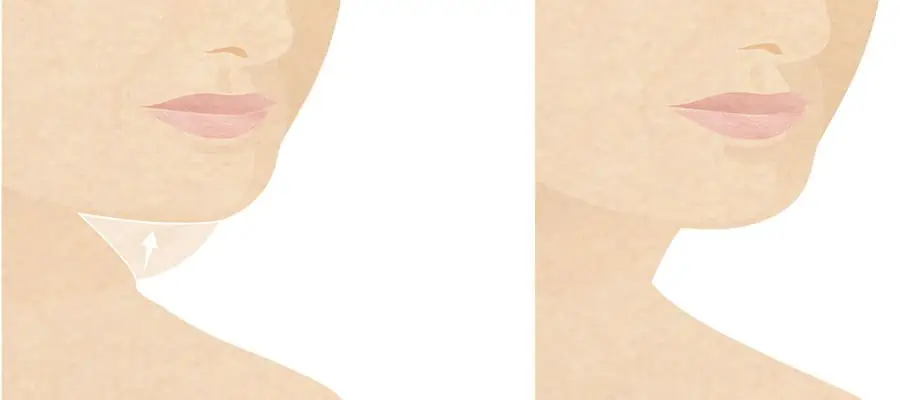 neck lift infographic