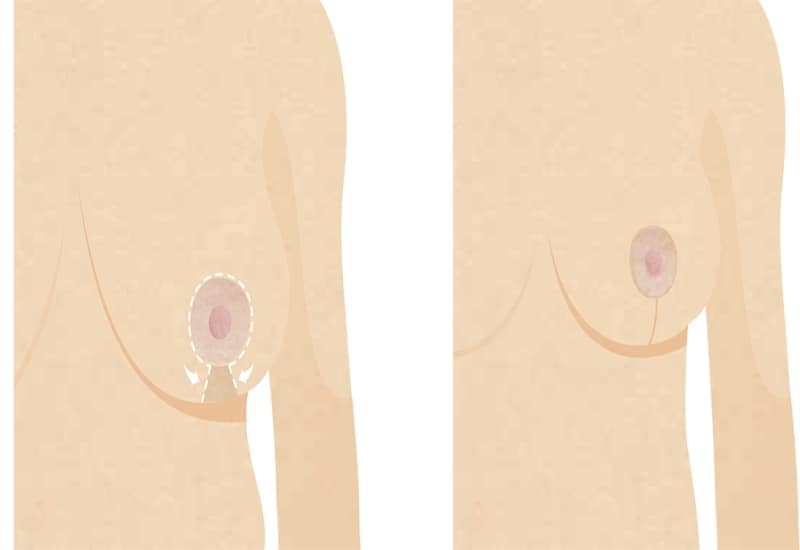 breast reduction infographic