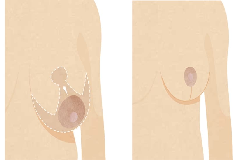 breast reduction infographic