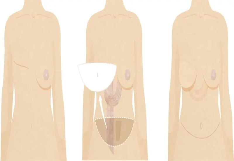TRAM Flap Breast Reconstruction