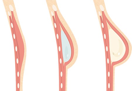 Two-Stage Implant Breast Reconstruction