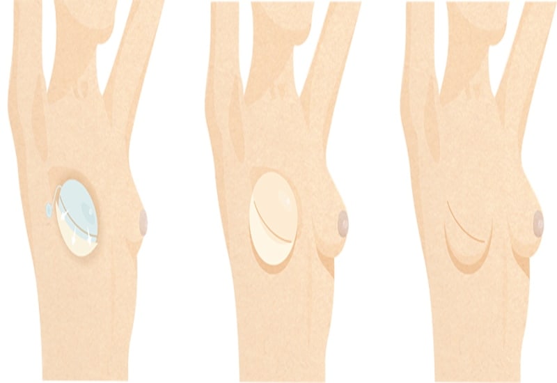 Two-Stage Implant Breast Reconstruction