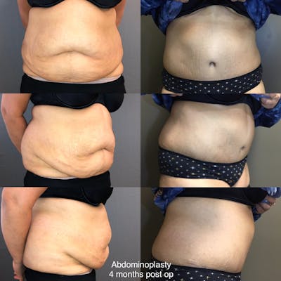 Abdominoplasty Before & After Gallery - Patient 215740 - Image 1