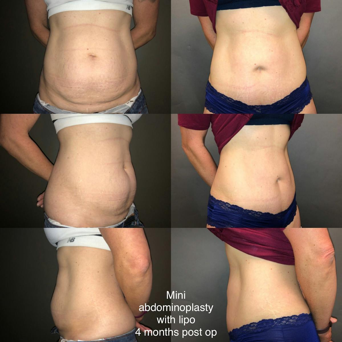 Abdominoplasty Before & After Gallery - Patient 138000 - Image 1