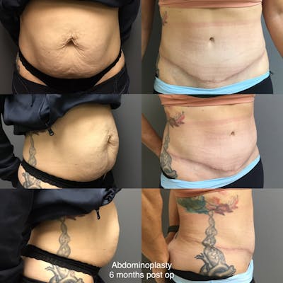 Abdominoplasty Before & After Gallery - Patient 843306 - Image 1