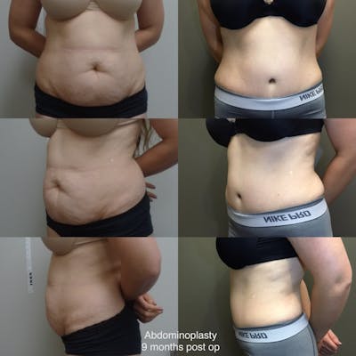 Abdominoplasty Before & After Gallery - Patient 147279 - Image 1